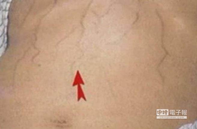 腹部肝硬化青筋图片图片